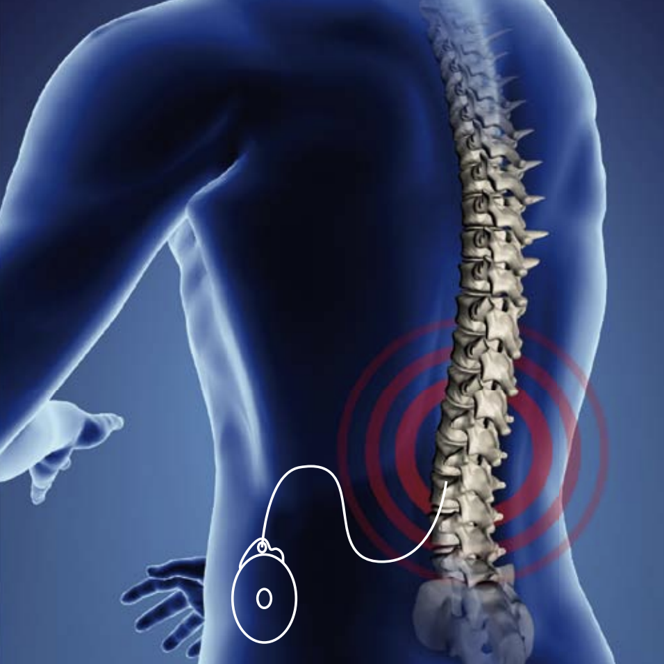 INTRATHECAL DRUG DELIVERY SYSTEMS FOR TREATING PAIN AND SPASMS